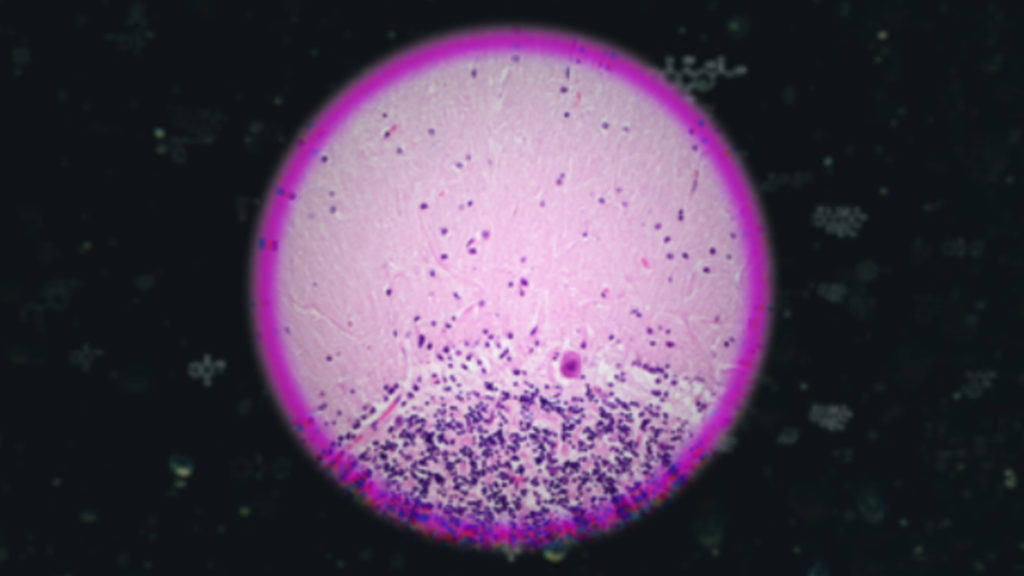 Coronavirus Autopsy Findings